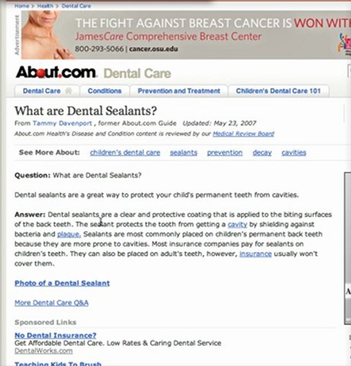 Gahanna Dentist- What are Dental Sealants?