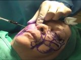 Fat injections Cheek, Eyelid for cheek lift and eye lift live video demo