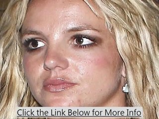 All-Natural acne Treatments