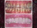 Full Mouth Reconstruction Rehabilitation Denver Highlands Ranch Dentist