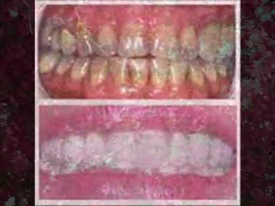 Full Mouth Reconstruction Rehabilitation Denver Highlands Ranch Dentist