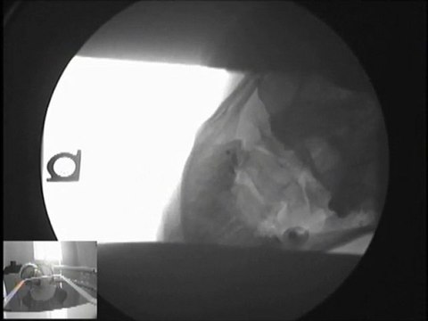 Car Accident |Whiplash | Vancouver Wa |Portland Or | Chiropractor | Personal Injury