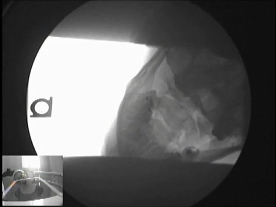 Car Accident |Whiplash | Vancouver Wa |Portland Or | Chiropractor | Personal Injury