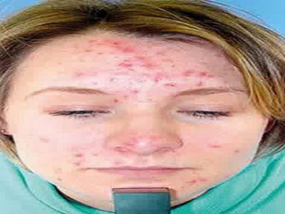 Teenage Acne