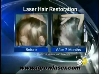 Severe Hair Loss in Women, iGrow for Women with Severe Hair Loss
