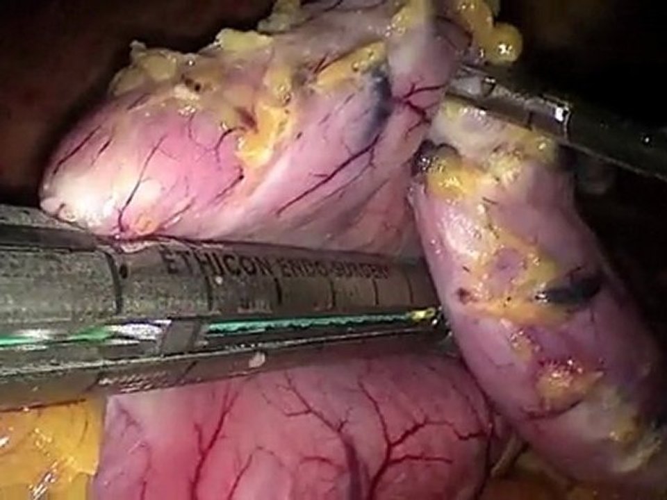 Sleeve gastrectomy