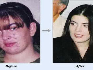 Teenage Acne Problems
