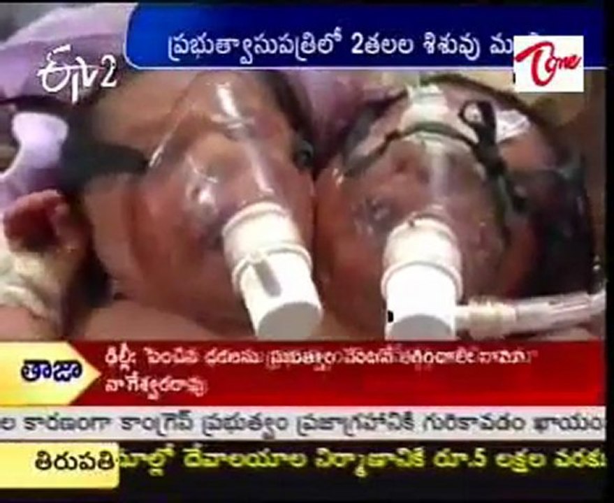 Two-Headed Baby Dies