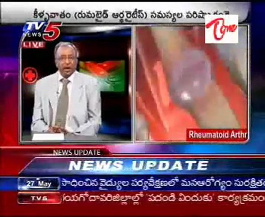 Rheumatoid Arthritis Problems - Doctor Suggestions - Part2