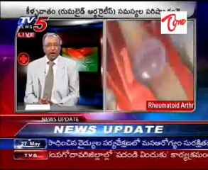 Rheumatoid Arthritis Problems - Doctor Suggestions - Part2