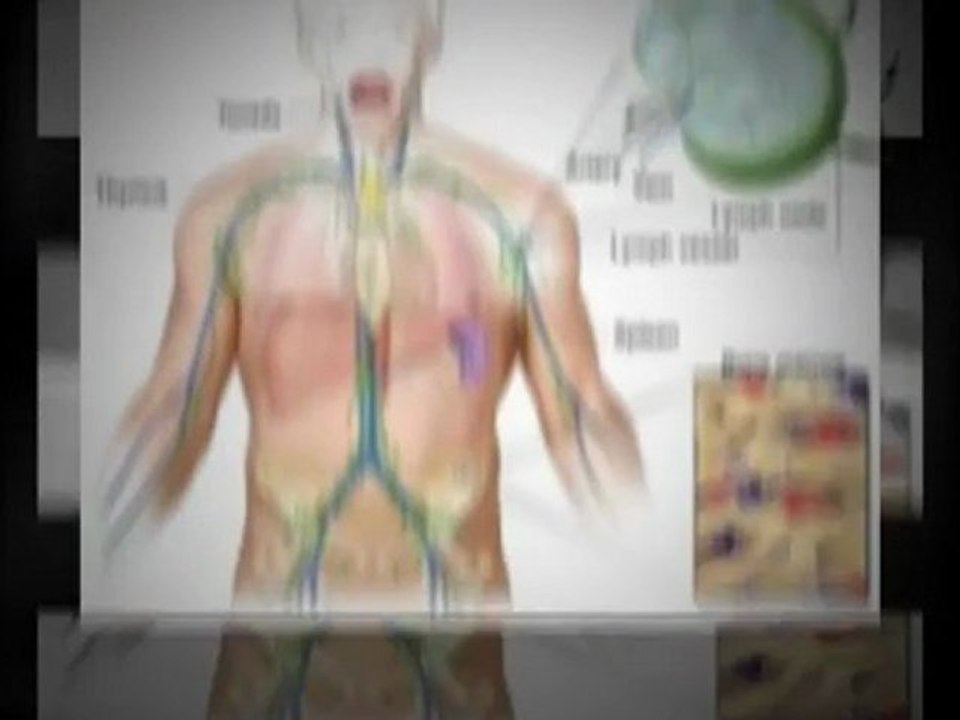 Treating swollen Lymph Nodes in Neck