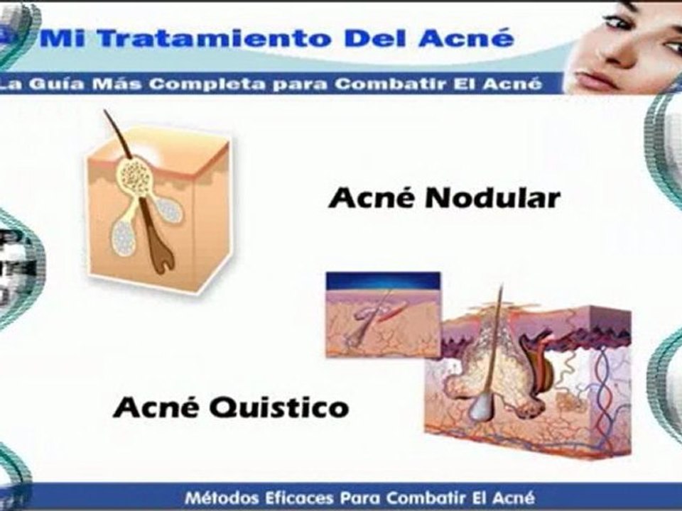 Acne En Los Jovenes