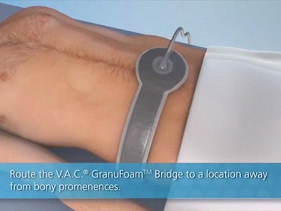 Pressure Ulcer Dressings VAC GranuFoam Bridge XG video Dailymotion