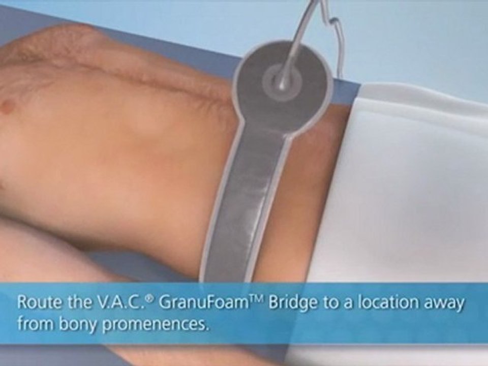 Pressure Ulcer Dressings | V.A.C. GranuFoam Bridge XG Dressing | KCI