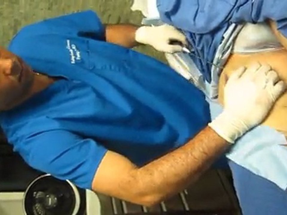 Laser Liposuction With Smartlipo-Whittier-Rowland Heights-Covina-West Covina-Cerritos-Glendora