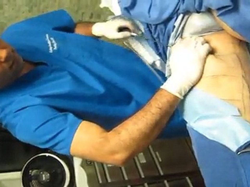 SmartLipo Laser Liposuction-Valley Aesthetics and Laser-626-961-7700