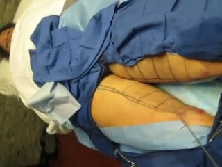 SmartLipo Laser Liposuction-Valley Aesthetics and Laser-626-961-7700