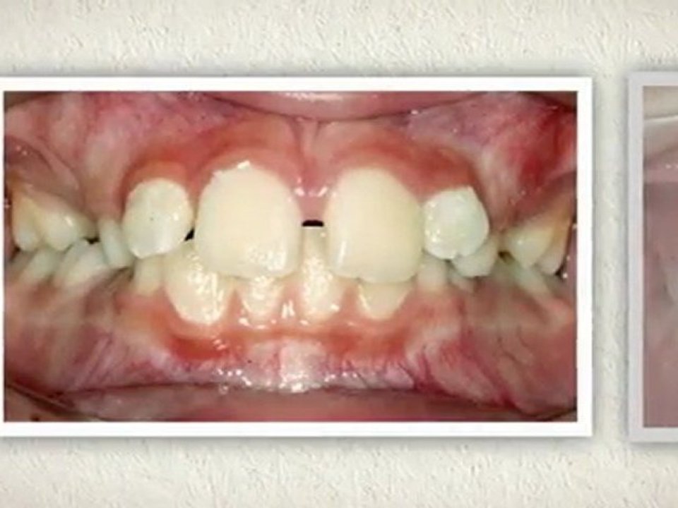 Finding A Great Orthodontist Westminster