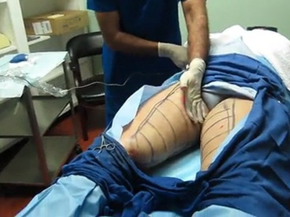 SmartLipo Laser Liposuction-Valley Aesthetics and Laser-626-961-7700
