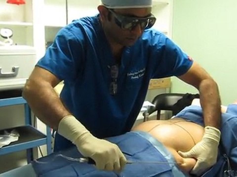 SmartLipo-Laser Liposuction-Valley Aesthetics and Laser-Hacienda Heights-626-961-7700