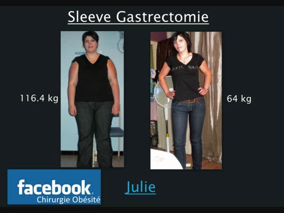 sleeve gastrectomie mon parcourt en 1 an et demie