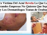 remedios caseros para el acne - tratamiento para el acne