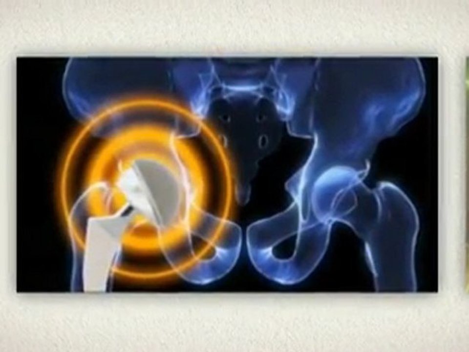 Recalled Hip Replacement - Make A Move
