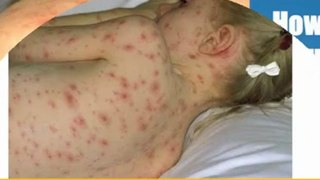 how to cure chickenpox - how to cure chicken pox - how to cure chicken pox in 3 days