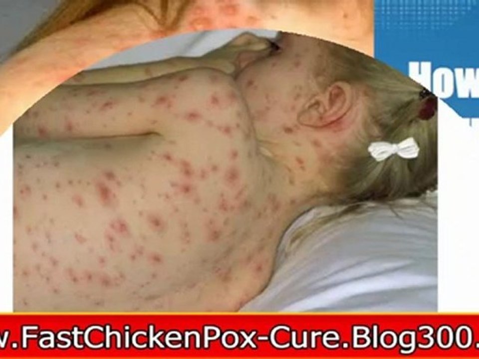 how to cure chickenpox - how to cure chicken pox - how to cure chicken pox in 3 days