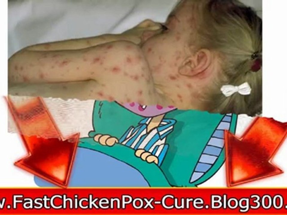 cure chickenpox - chickenpox cure - chickenpox cures - chicken pox cure