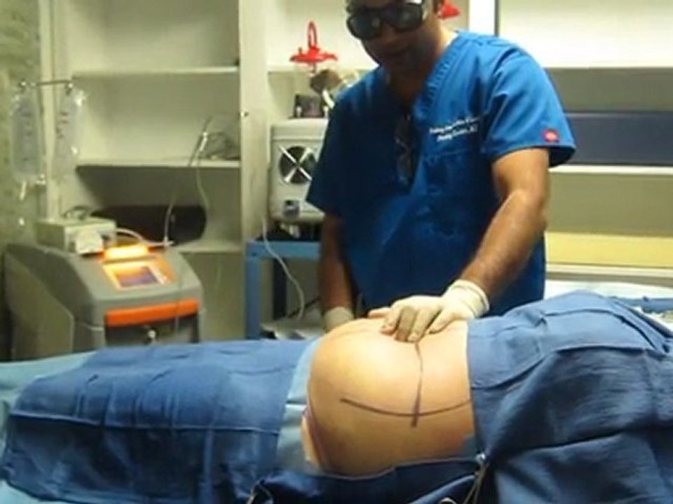 Laser Liposuction-Abdomen and Flanks-SmartLipo-Valley Aesthetics and Laser-626-961-7700-Pankaj Karan,M.D.,Board Certified