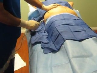 SmartLipo_Laser Liposuction_Valley Aesthetics and Laser-Hacienda Heights-626-961-7700