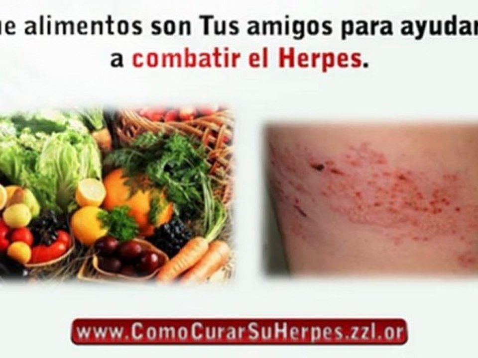 Método #1 Eficaz para Eliminar por completo su Herpes ¡Rapido e Infalible!