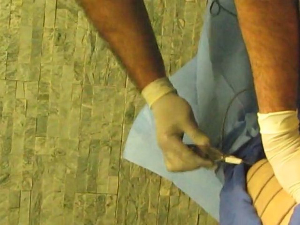 SmartLipo Laser Liposuction With SmartLipo-Valley Aesthetics and Laser-626-961-7700