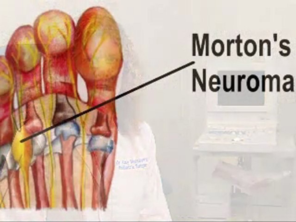 Neuromas - Podiatrist in Cherry Hill, Voorhees and West Dept