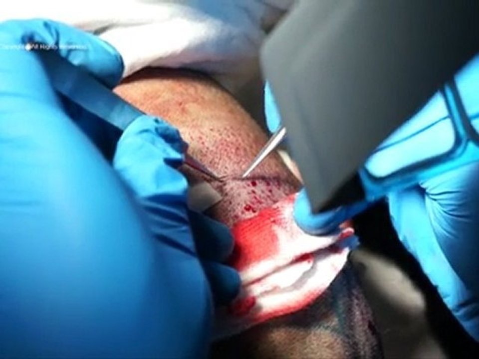 Operation FUE_ESP