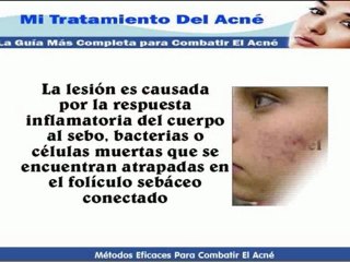 Secuelas A Causas Del Acné