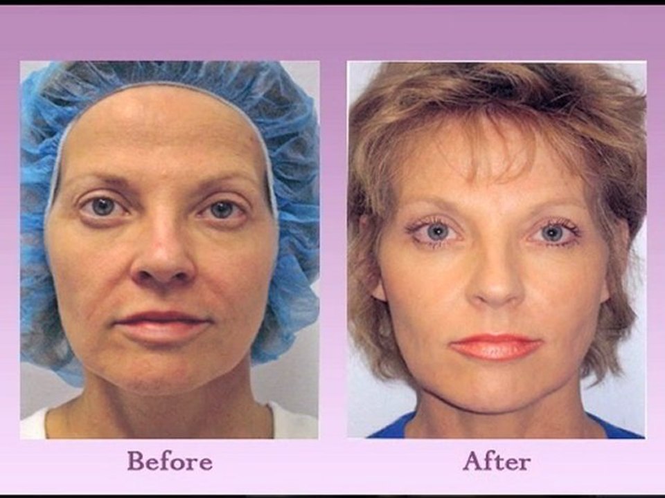 Austin Non Surgical Face Lift – How Does the Thread Lift Procedure Work?