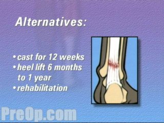Achilles Tendon Repair Surgery  - Alternatives