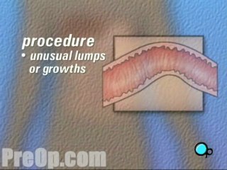 Endoscopy - Upper GI  - Alternatives