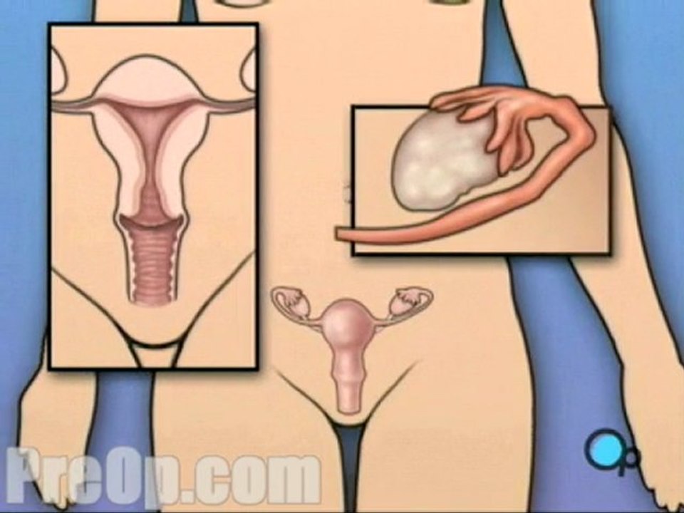 Hysterectomy Removal of Uterus, Ovaries and Fallopian Tubes Surgery  - Alternatives