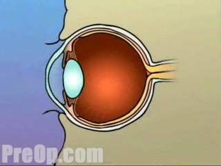 Laser Eye Surgery PRK  - Alternatives