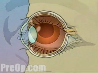 Laser Eye Lasik  - Alternatives