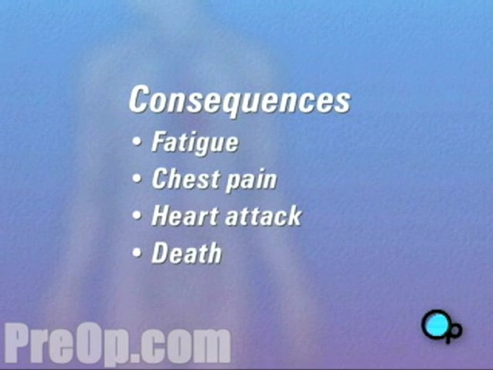 Coronary Artery Bypass Graft (CABG) Surgery  - Alternatives