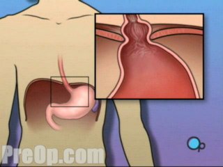 Hernia - Hiatal Open Repair  - Alternatives