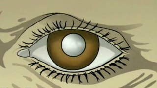 Large Incision Cataract  - Alternatives