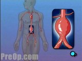 Abdominal Aortic Aneurysm - Open Repair  - Alternatives