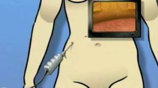 Anti-Reflux Laparoscopy Surgery  - Alternatives
