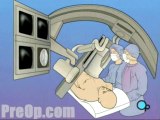 Balloon Angioplasty Coronary Angioplasty  - Alternatives