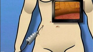 Gastric Adjustable Band Laparoscopic Surgery  - Alternatives